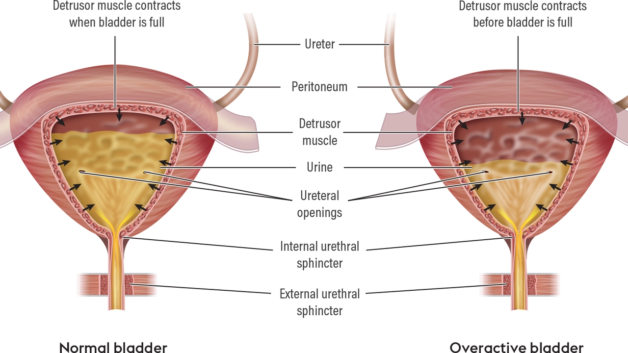 Desmopressin for the Management of Urinary Incontinence: A Comprehensive Review